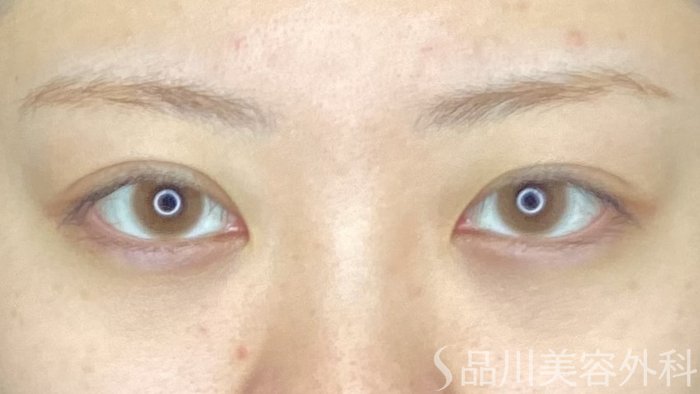 症例NO.67150のAFTER写真