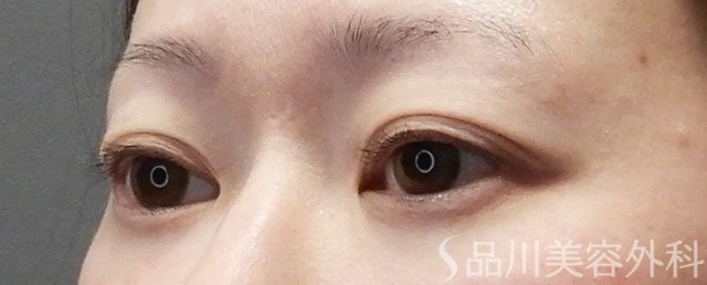 症例NO.74127のBEFORE写真