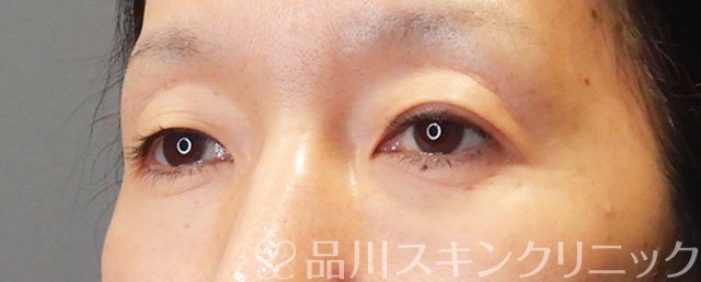 症例NO.75243のBEFORE写真