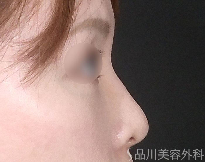 症例NO.67683のBEFORE写真