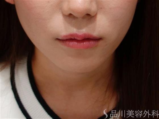 症例NO.50616のBEFORE写真