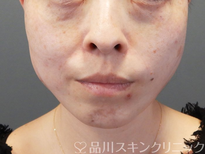 症例NO.72769のAFTER写真