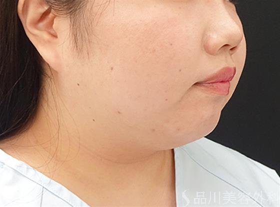 症例NO.40591のBEFORE写真