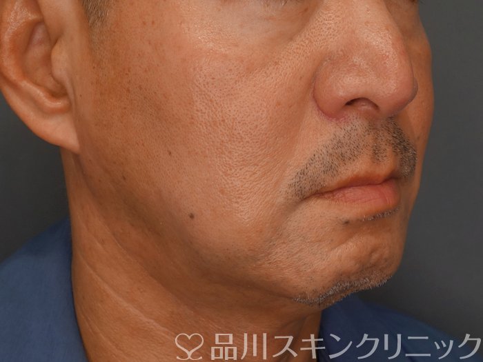 症例NO.73899のBEFORE写真