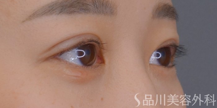 症例NO.73792のAFTER写真