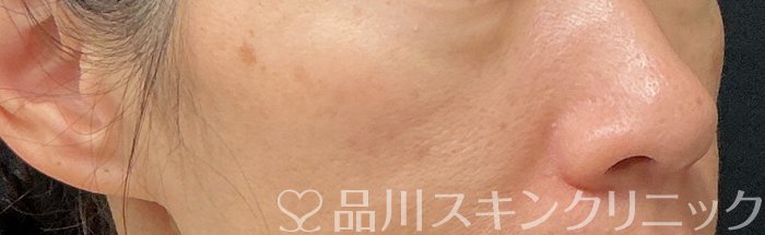 症例NO.74146のBEFORE写真