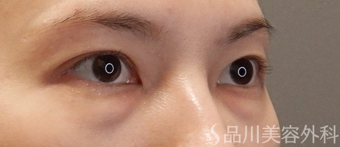 症例NO.71728のBEFORE写真