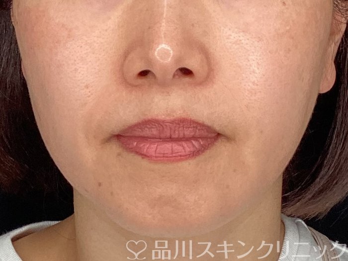 症例NO.64929のBEFORE写真