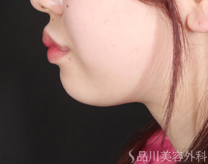 症例NO.72588のBEFORE写真