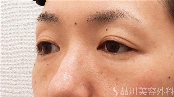 症例NO.61037のBEFORE写真