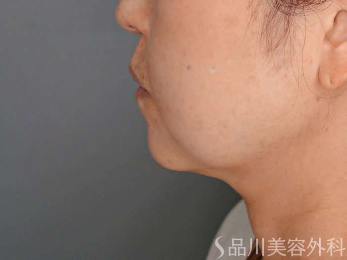 症例NO.70554のBEFORE写真
