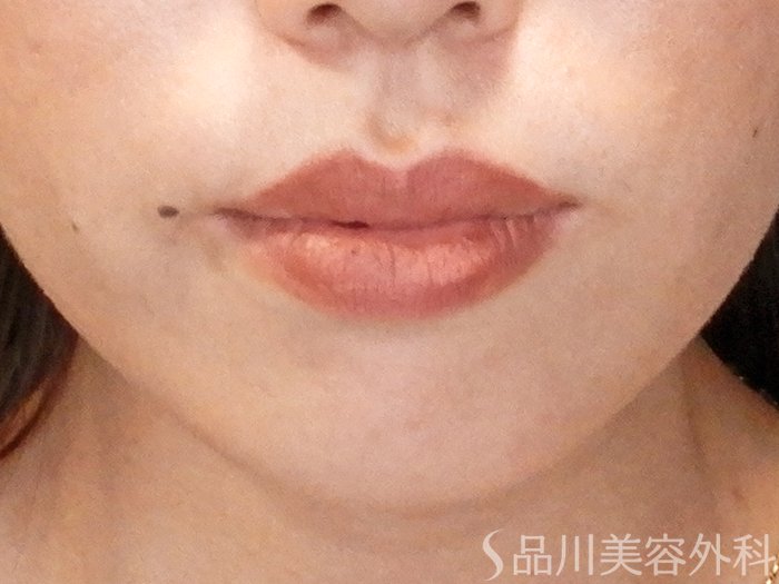 症例NO.65348のBEFORE写真