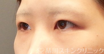 症例NO.65680のBEFORE写真