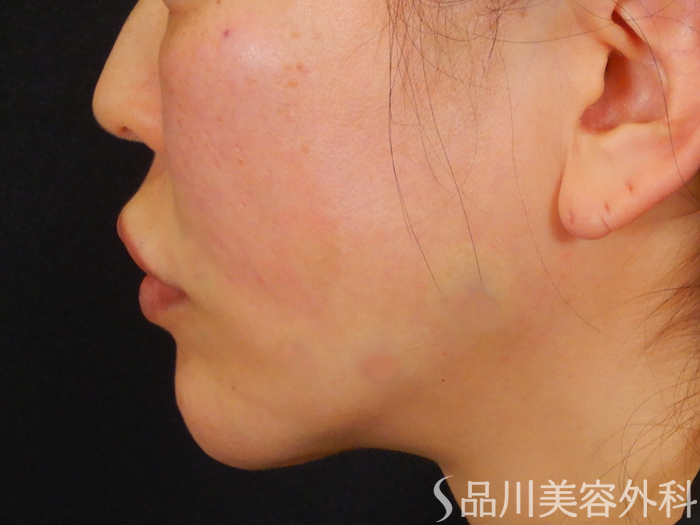 症例NO.67740のAFTER写真