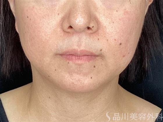 症例NO.61855のBEFORE写真