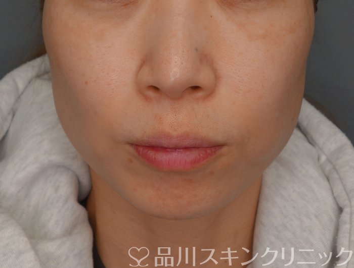 症例NO.74439のBEFORE写真