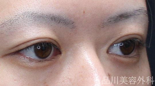 症例NO.74948のAFTER写真