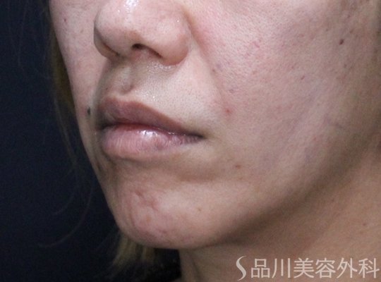 症例NO.73347のAFTER写真