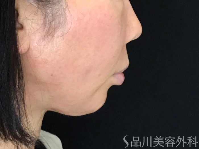 症例NO.69744のAFTER写真