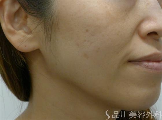 症例NO.41413のBEFORE写真