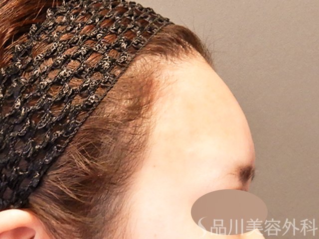 症例NO.69953のAFTER写真