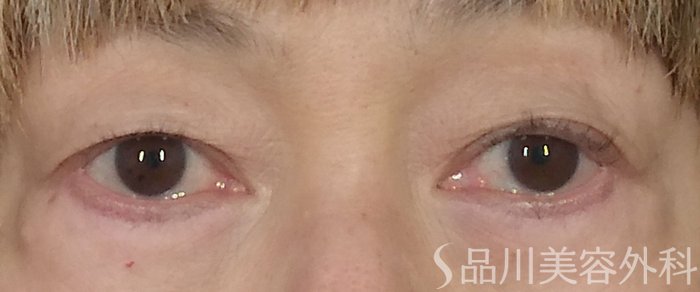症例NO.65031のBEFORE写真