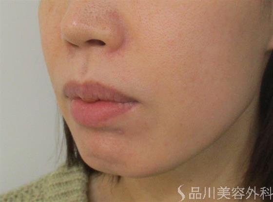症例NO.53780のBEFORE写真