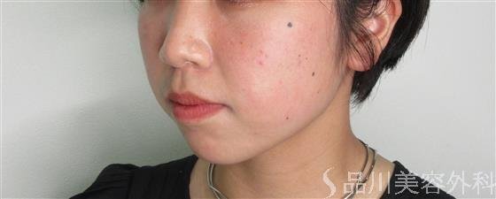 症例NO.54564のBEFORE写真