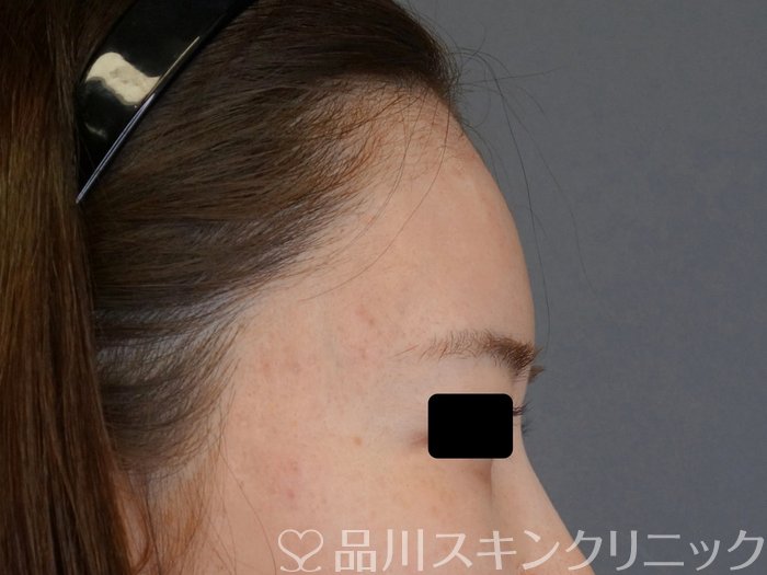 症例NO.74516のAFTER写真