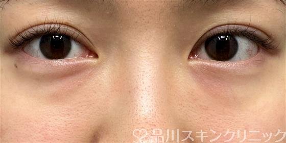 症例NO.61637のBEFORE写真