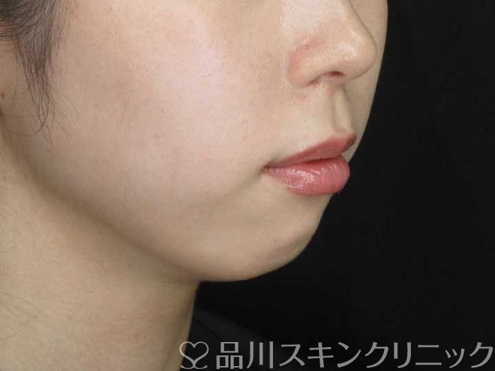 症例NO.66712のBEFORE写真