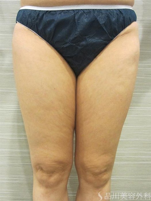 症例NO.23310のAFTER写真