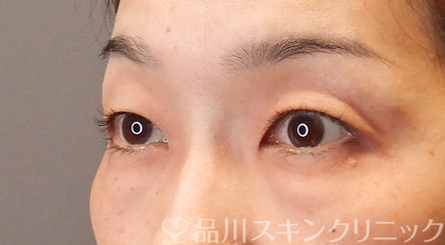症例NO.75318のBEFORE写真