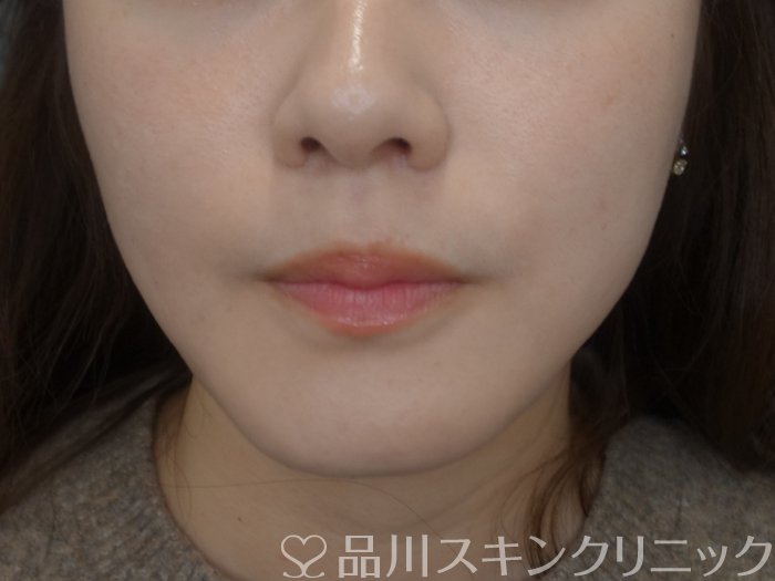 症例NO.73671のAFTER写真