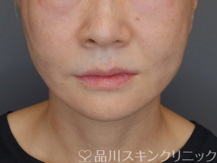 症例NO.71821のAFTER写真