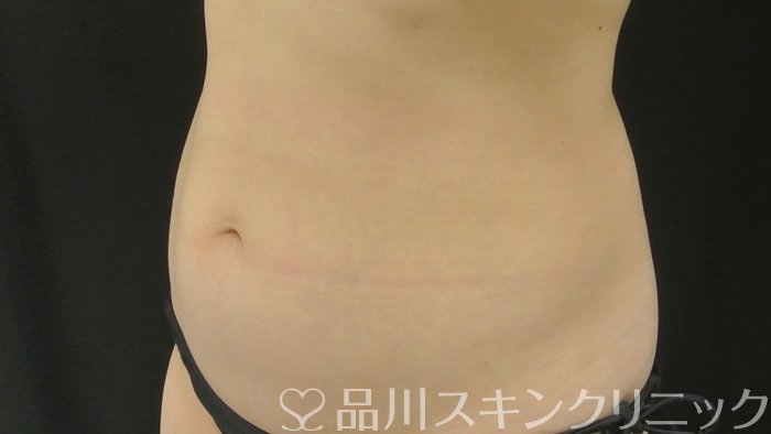 症例NO.70814のBEFORE写真