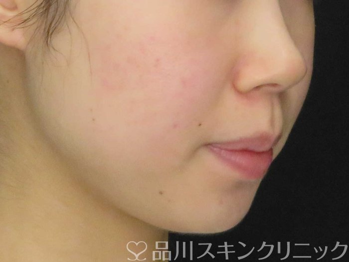 症例NO.65475のAFTER写真