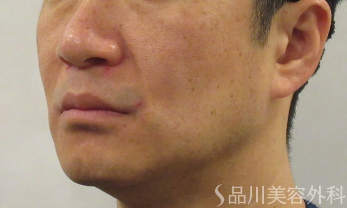 症例NO.73336のBEFORE写真