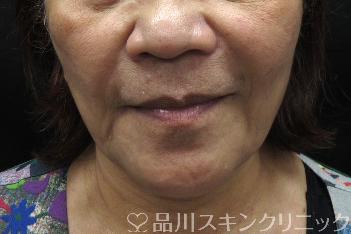 症例NO.74642のBEFORE写真