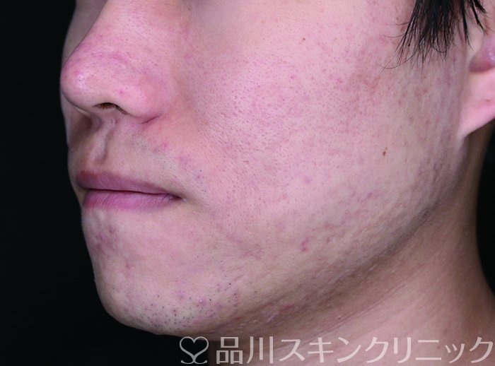 症例NO.73016のBEFORE写真