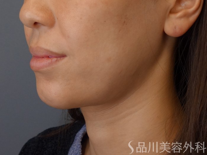 症例NO.72597のBEFORE写真