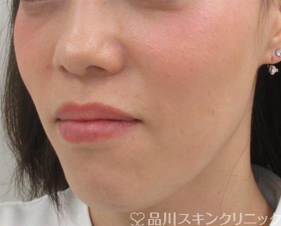 症例NO.29709のBEFORE写真
