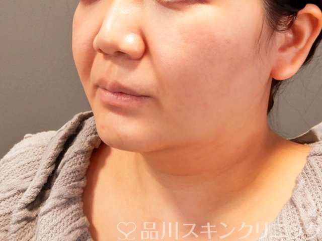 症例NO.69394のAFTER写真