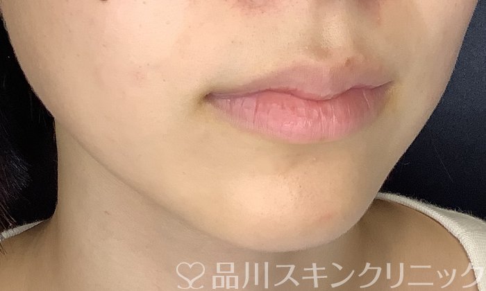 症例NO.70269のAFTER写真