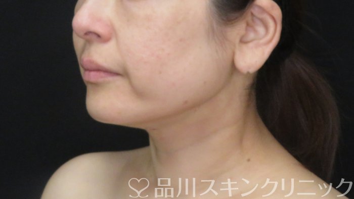 症例NO.71575のAFTER写真