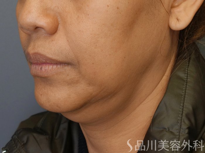 症例NO.72276のBEFORE写真