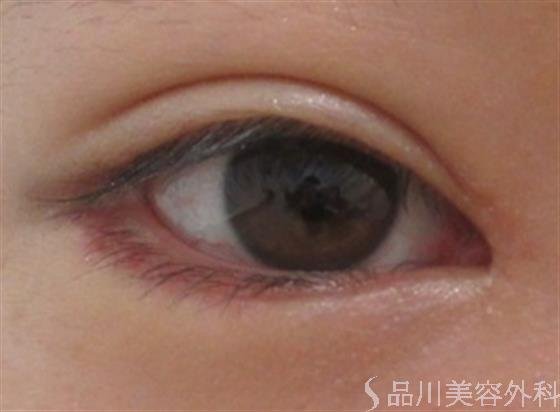 症例NO.23523のAFTER写真