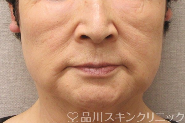 症例NO.71561のBEFORE写真