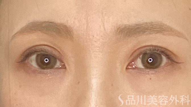 症例NO.71146のAFTER写真