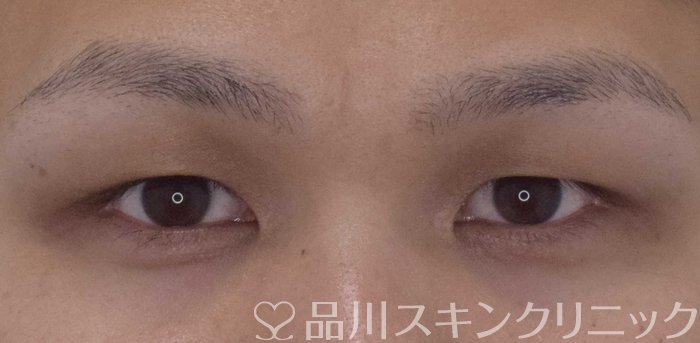 症例NO.62092のBEFORE写真